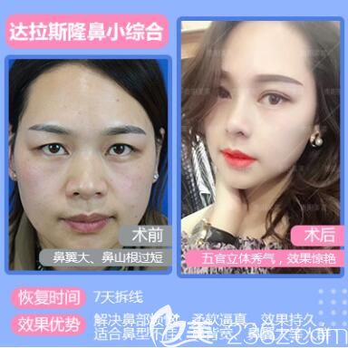 貴陽美萊雙眼皮隆鼻