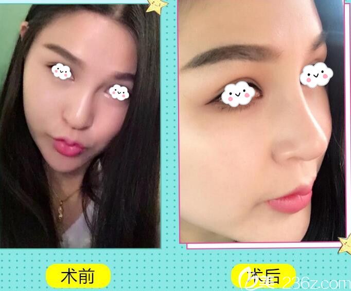 韓國麗儂整形醫(yī)院鼻綜合隆鼻案 例 韓國麗儂整形醫(yī)院鼻綜合隆鼻案 例