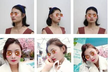 上海時光整形外科醫(yī)院姚全豊顴骨整形真人案例