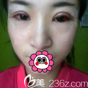 雙眼皮術(shù)后修復(fù)二天的時(shí)候 雙眼皮術(shù)后修復(fù)二天的時(shí)候