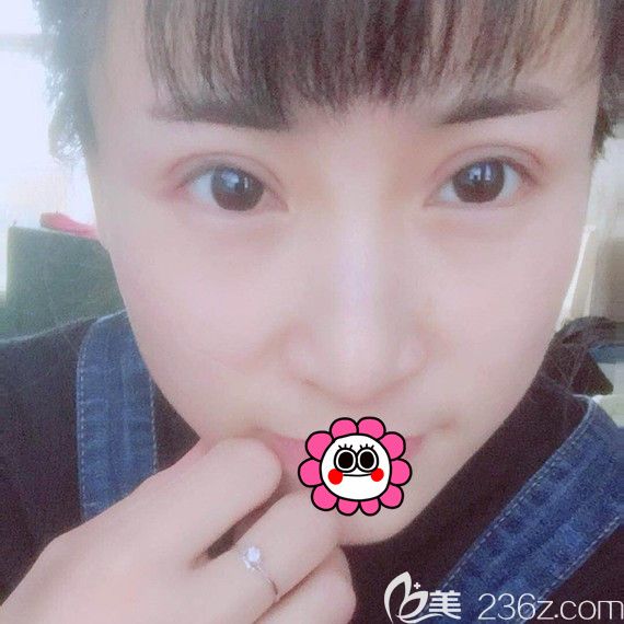 哈爾濱臻美做眼修復(fù)術(shù)后半個(gè)月 哈爾濱臻美做眼修復(fù)術(shù)后半個(gè)月