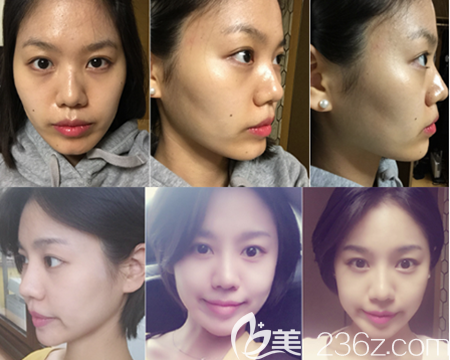 韓國那木面部提升案例 韓國那木面部提升案例