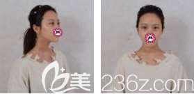 在北京美萊做眼綜合前樣子 在北京美萊做眼綜合前樣子