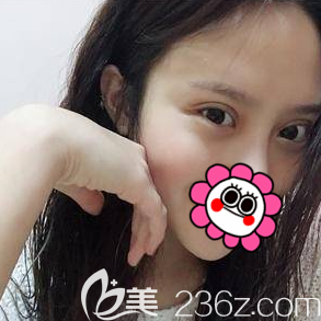 在北京美萊做眼綜合第35天效果 在北京美萊做眼綜合第35天效果
