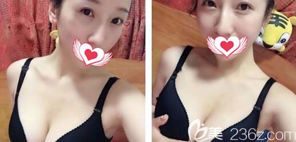 假體隆胸一個(gè)月短時(shí)間側(cè)睡是沒(méi)有問(wèn)題