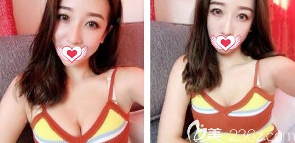 找昆明韓辰陳寧做了曼托假體豐胸手術(shù)后，才知道假體隆胸毛面和光面的區(qū)別在哪