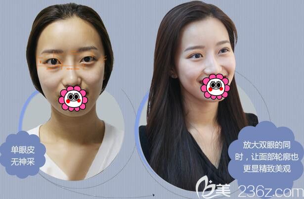 王丹丹雙眼皮案例效果