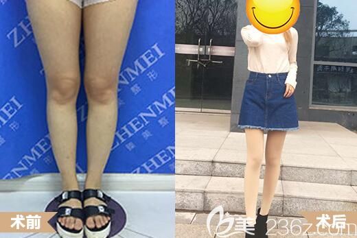 哈爾濱臻美吸脂瘦大腿案例