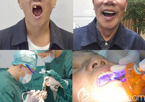 口腔種植牙案例效果圖