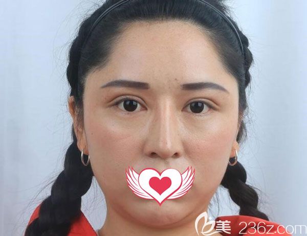 昆明韓辰整形做光纖溶脂手術(shù)前 昆明韓辰整形做光纖溶脂手術(shù)前