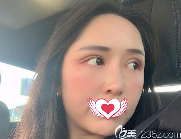 光纖溶脂瘦臉第7天慢慢開始瘦了 光纖溶脂瘦臉第7天慢慢開始瘦了