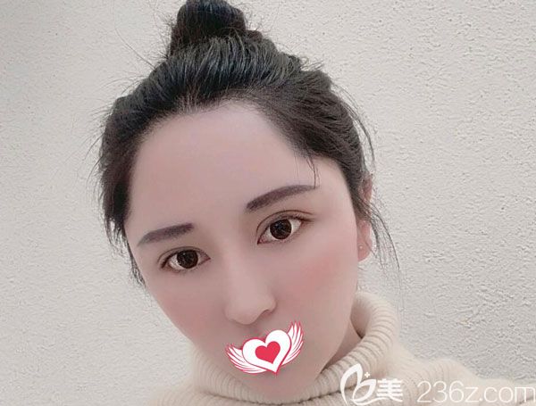 瘦臉不是吹的，來看我在昆明韓辰找陳寧做光纖溶脂瘦臉一個(gè)月的恢復(fù)效果圖