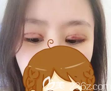 包頭華美全切雙眼皮+去皮去脂第三天效果 包頭華美全切雙眼皮+去皮去脂第三天效果