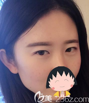 包頭華美整形醫(yī)院割雙眼皮前 包頭華美整形醫(yī)院割雙眼皮前