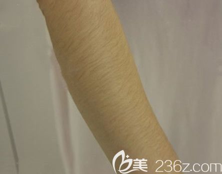 包頭華美整形醫(yī)院手臂脫毛前 包頭華美整形醫(yī)院手臂脫毛前