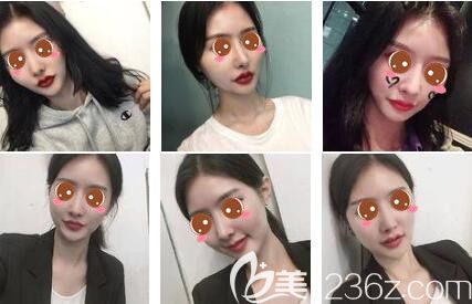 上海時光整形外科醫(yī)院自體脂肪面部填充真人案例