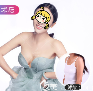 北京美萊董巖巖醫(yī)生曼托圓形假體隆胸案例