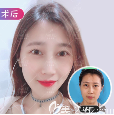 北京美萊祛眼袋案例