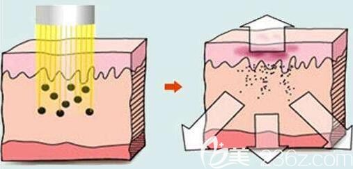 上海光博士醫(yī)療美容門診部彭春激光去色素原理 上海光博士醫(yī)療美容門診部彭春激光去色素原理