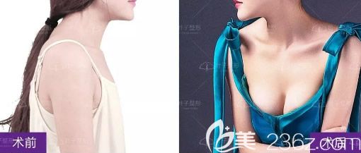 包頭葉子隋立強假體隆胸案例 包頭葉子隋立強假體隆胸案例