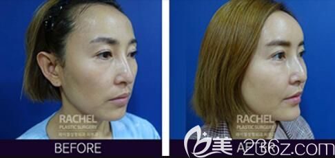 韓國蕾切爾整形外科自體脂肪面部填充<span style= 韓國蕾切爾整形外科自體脂肪面部填充<span style=