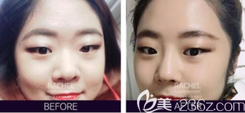 韓國蕾切爾整形外科misko隆鼻<span style= 韓國蕾切爾整形外科misko隆鼻<span style=