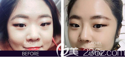 韓國(guó)蕾切爾柳承來(lái)院長(zhǎng)misko隆鼻案例前后效果對(duì)比圖