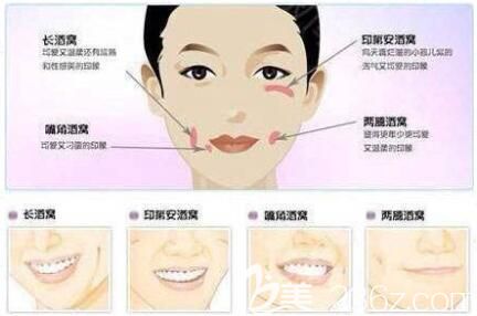 酒窩成型術(shù)的三種方法 酒窩成型術(shù)的三種方法