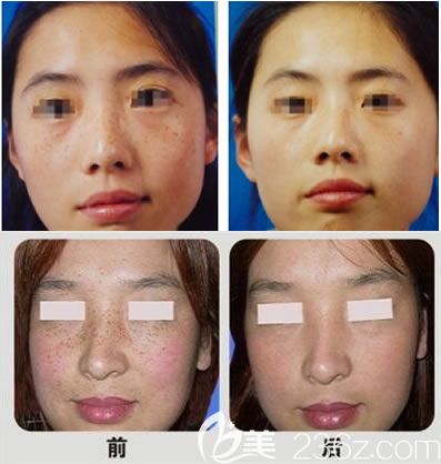 永康光大醫(yī)院楊鳳婷激光祛雀斑案例 永康光大醫(yī)院楊鳳婷激光祛雀斑案例