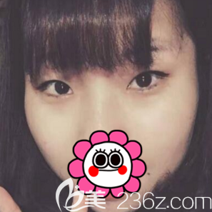 在北京京韓做開眼角切開雙眼皮前樣子 在北京京韓做開眼角切開雙眼皮前樣子