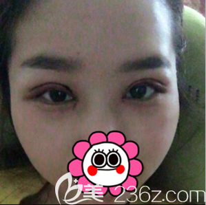 喬愛軍醫(yī)生給我做開眼角切開雙眼皮第二天樣子 喬愛軍醫(yī)生給我做開眼角切開雙眼皮第二天樣子