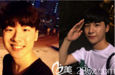 韓國Glory整形醫(yī)院男士隆鼻手術(shù)效果圖 韓國Glory整形醫(yī)院男士隆鼻手術(shù)效果圖