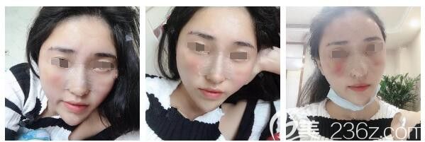 做完脂肪填充+隆鼻術后五天恢復 做完脂肪填充+隆鼻術后五天恢復