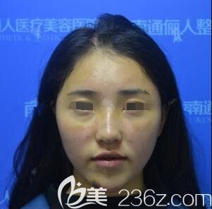 術后一周到醫(yī)院復查面部恢復情況 術后一周到醫(yī)院復查面部恢復情況