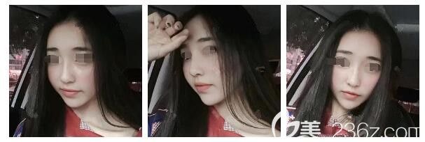 二次脂肪填充術后半個月恢復情況 二次脂肪填充術后半個月恢復情況