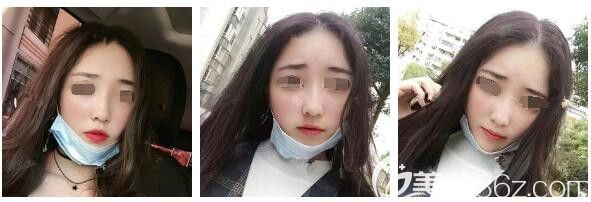 三個月蛻變自然氧氣少女臉的秘訣是在南通儷人連天美做了腫脹輕恢復(fù)的自體脂肪面部填充+假體隆鼻