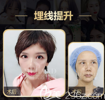 埋線提升的案例