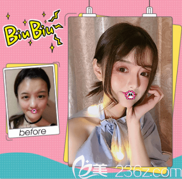 北京壹加壹張綠峰埋線雙眼皮案例