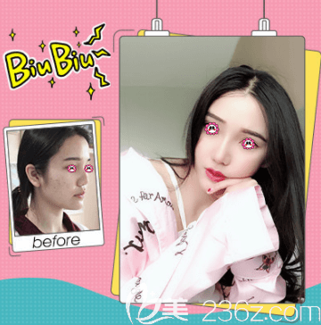 北京壹加壹張綠峰硅膠隆鼻案例