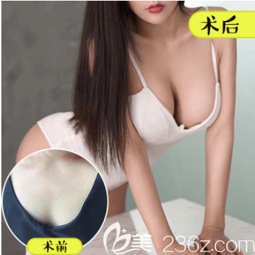 北京壹加壹王珂假體隆胸案例