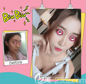 北京壹加壹丁洪如面部脂肪填充案例