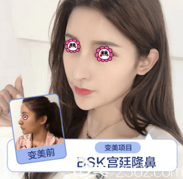 北京藝星薛軼群BSK宮廷隆鼻案例