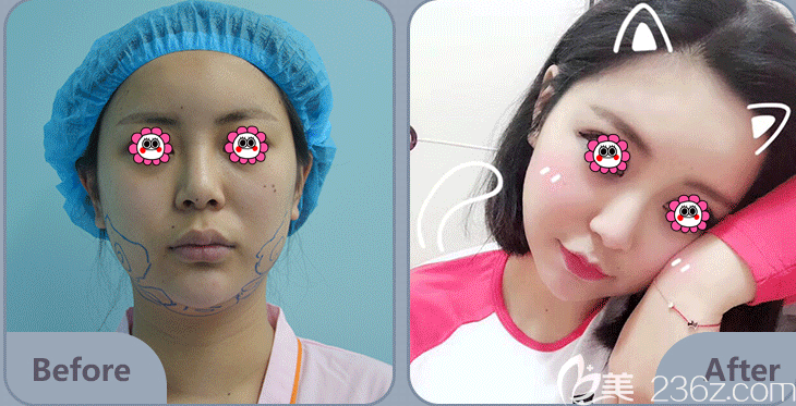 北京藝星鄭仕平面部吸脂案例