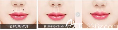 韓國MVP整形M唇整形 韓國MVP整形M唇整形