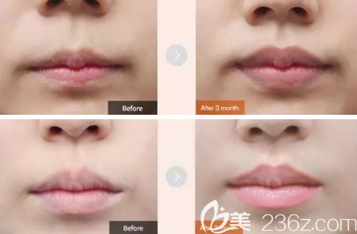 韓國MVP唇部整形案例 韓國MVP唇部整形案例