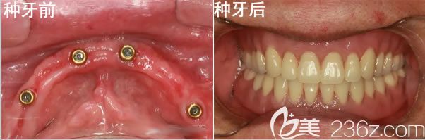 北京維樂口腔全口種植牙<span style=