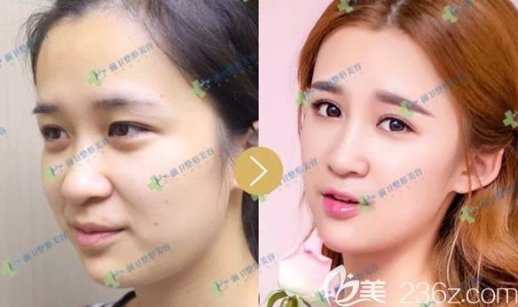 崔在宜昌前衛(wèi)整形醫(yī)院坐診時(shí)打造的玻尿酸注射美容效果圖 崔在宜昌前衛(wèi)整形醫(yī)院坐診時(shí)打造的玻尿酸注射美容效果圖