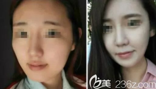 <!--<i data=20240703-sp></i>-->王俠下頜角整形前后對(duì)比照片