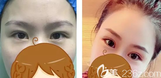 西安整形醫(yī)生張沙沙雙眼皮案例 西安整形醫(yī)生張沙沙雙眼皮案例