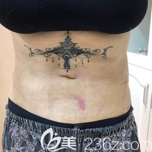 <i data-id='8cb641b3-5c99-43b6-9d58-783ebde4edf3' style='display:none;'></i>腰腹吸脂拆線后效果 <i data-id='8cb641b3-5c99-43b6-9d58-783ebde4edf3' style='display:none;'></i>腰腹吸脂拆線后效果